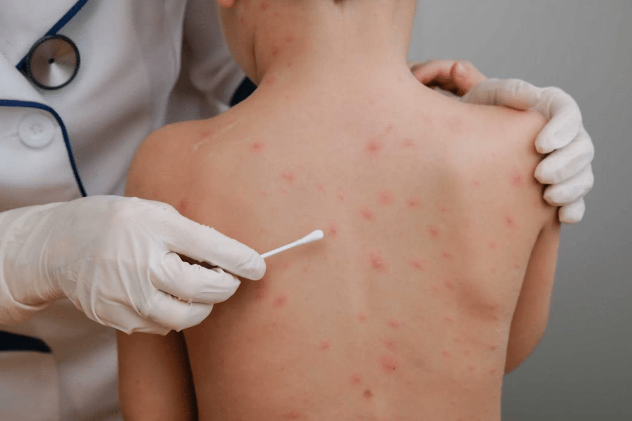 Querétaro suma 14 casos de sarampión en 2026