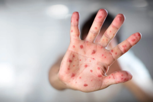 Sarampión en Querétaro suma 12 casos en 2026