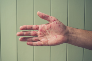 Sarampión en Querétaro suma 18 casos