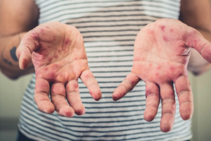 Sarampión en Querétaro suma 19 casos en 2026